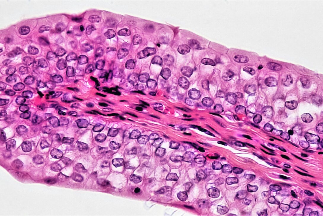 bladder cancer, urothelial carcinoma, transitional cell carcinoma