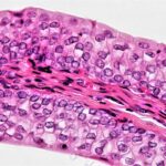 bladder cancer, urothelial carcinoma, transitional cell carcinoma