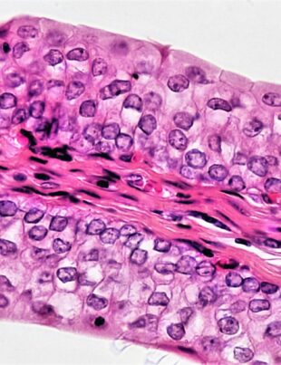 bladder cancer, urothelial carcinoma, transitional cell carcinoma