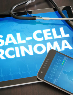 basal cell carcinoma