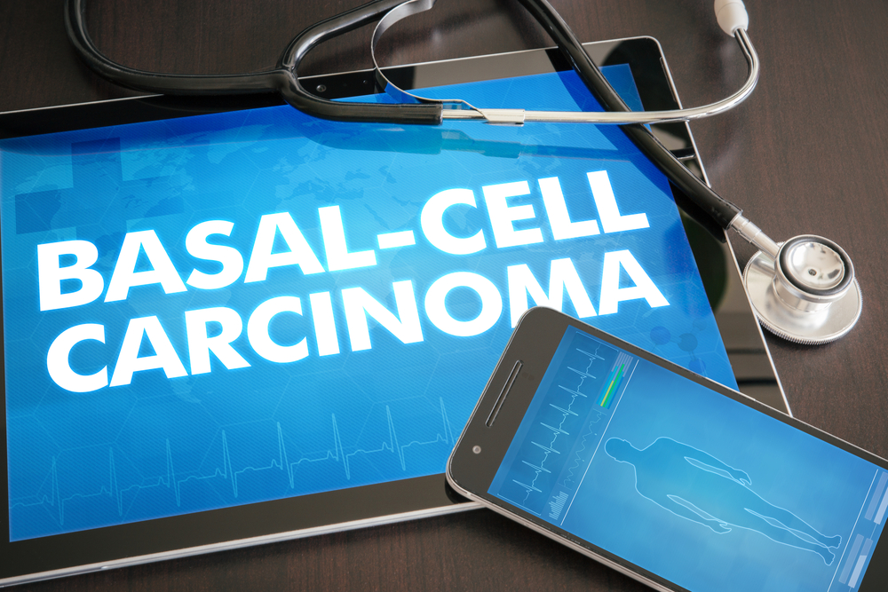 basal cell carcinoma